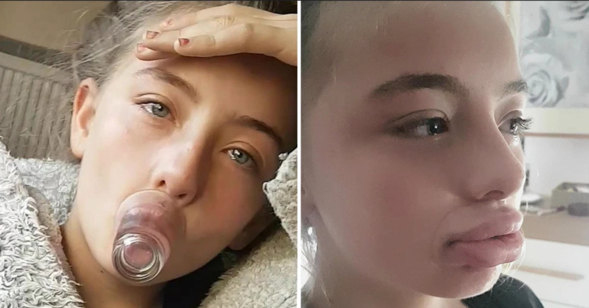Is the Kylie Jenner Lip Challenge Permanent?
