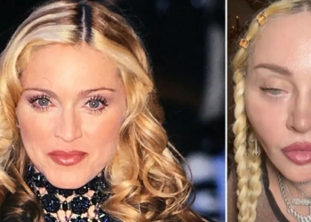 What Happened To Madonna’s Face? The Queen Of Pop’s Plastic Surgery Details