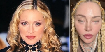 What Happened To Madonna’s Face? The Queen Of Pop’s Plastic Surgery Details
