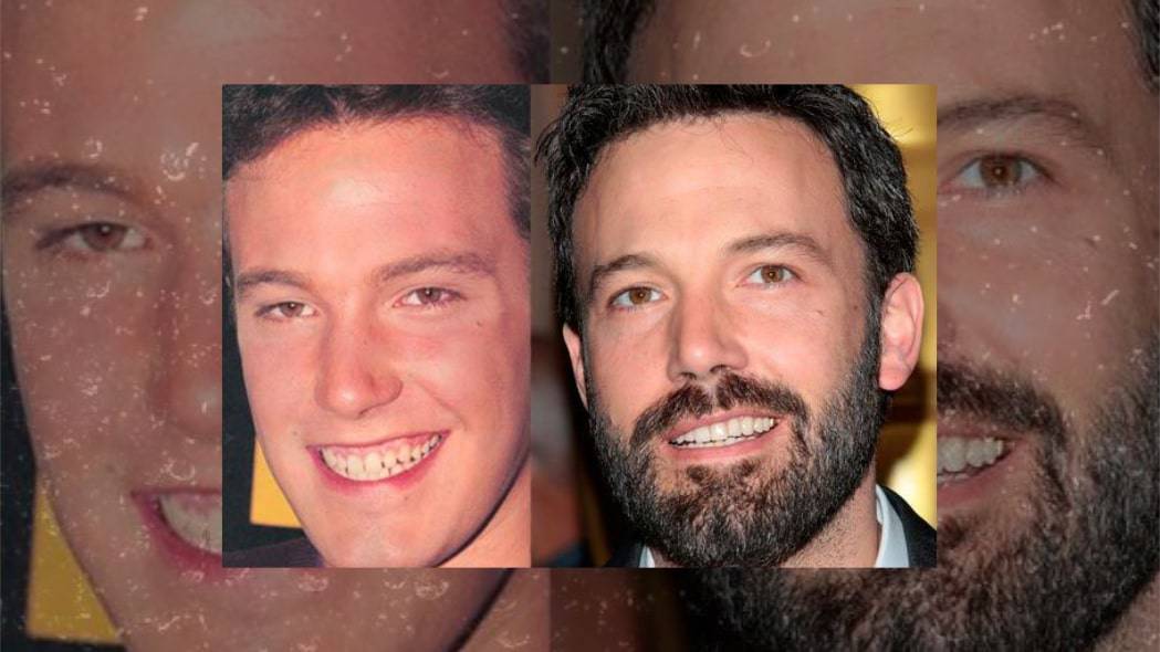 Ben Affleck's Teeth Before And After: Secret Reveled 