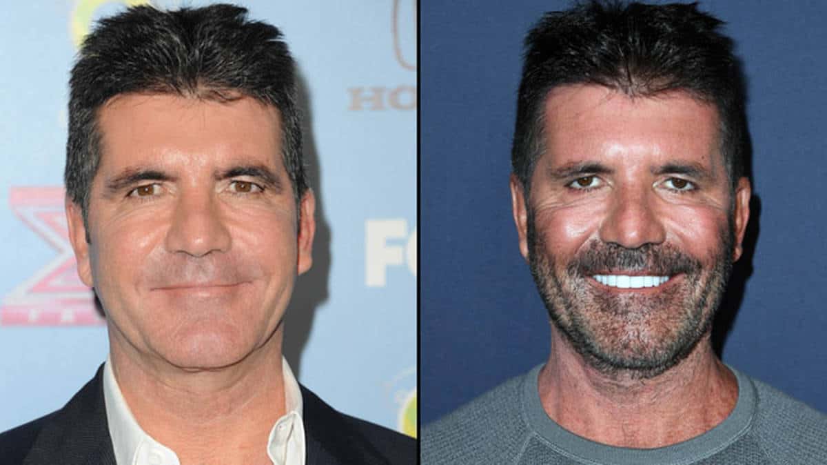 What Happened To Simon Cowell's Face? 
