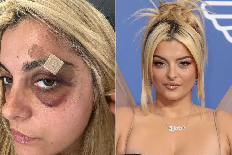 Bebe Rexha injured after being hit in the face by concertgoer's phone