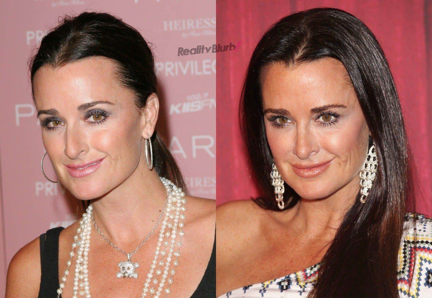 Kyle Richards Before and After (Credits: US Weekly)