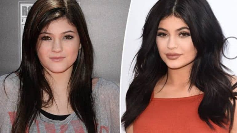 Kylie Jenner Before And After: The Beauty Mogul Confessed Undergoing ...