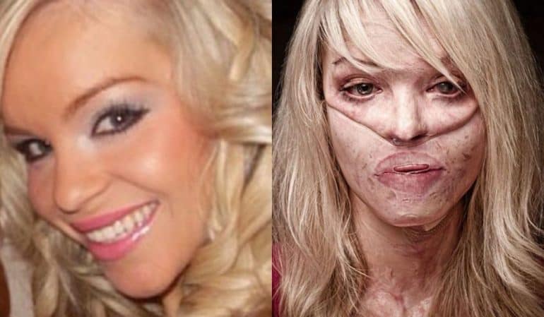 Katie Piper Before And After Surviving A Brutal Acid Attack OtakuKart   Katie Piper 770x449 