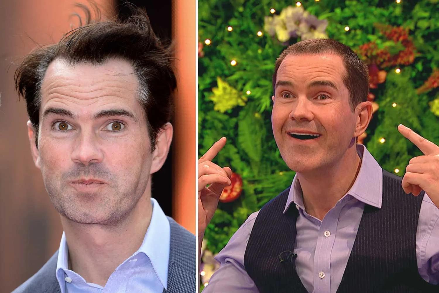Jimmy Carr Before and After: Did Jimmy Carr Get Plastic Surgery?