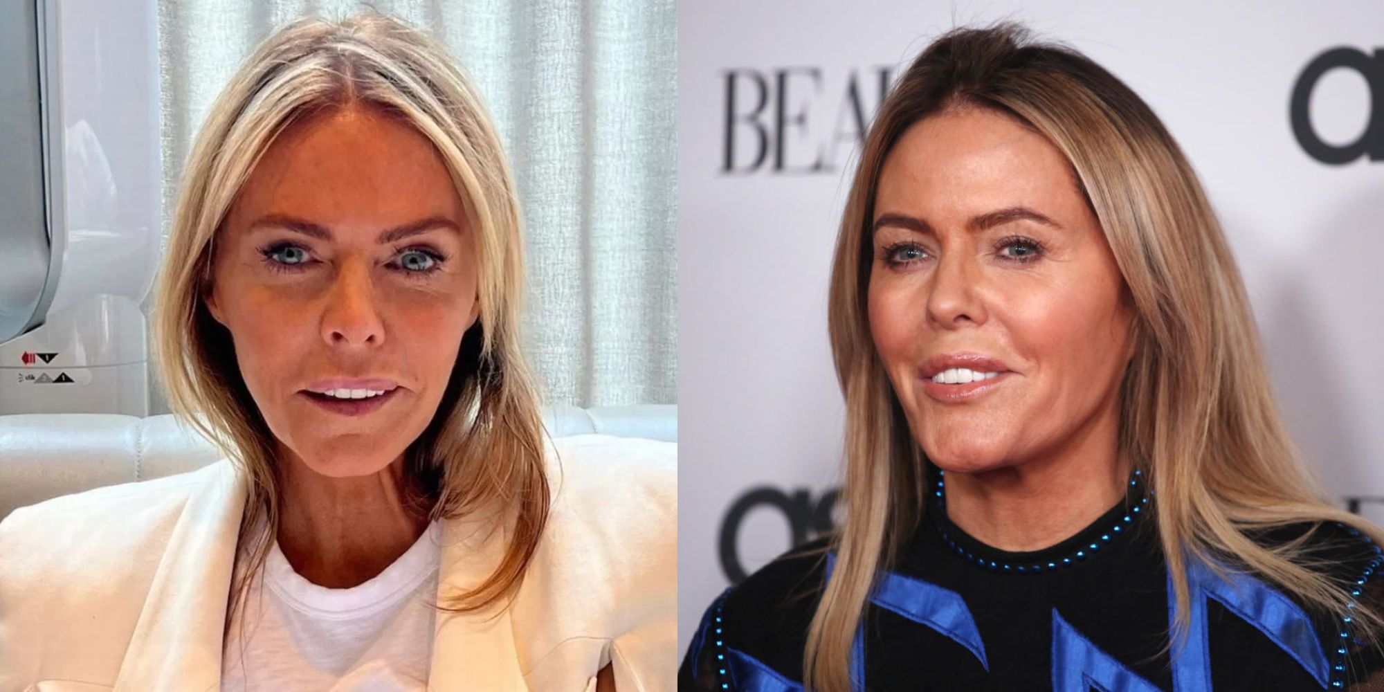 Patsy Kensit Before and After: Did She Do Any Plastic Surgery?
